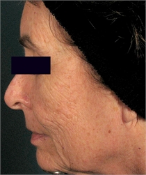 Deep facial wrinkles before DeepFX