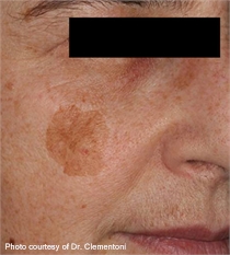 Keratosis brown spots before laser treatment